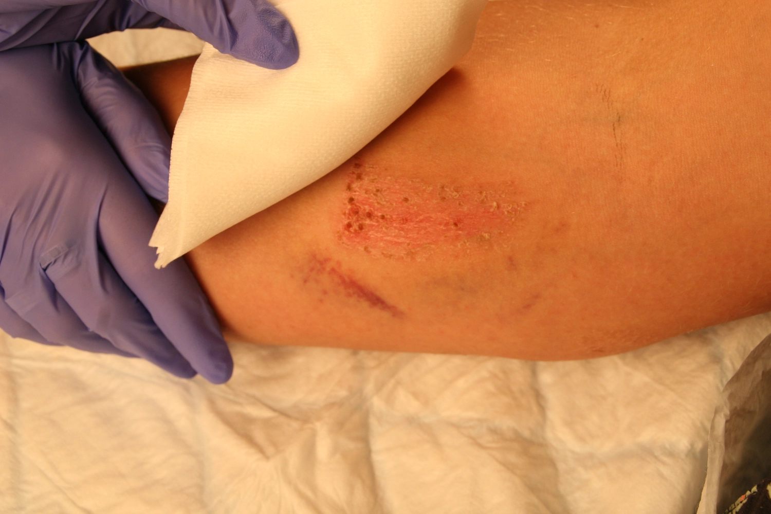 Wundtherapie Eifel - Meike Keul - Wunde