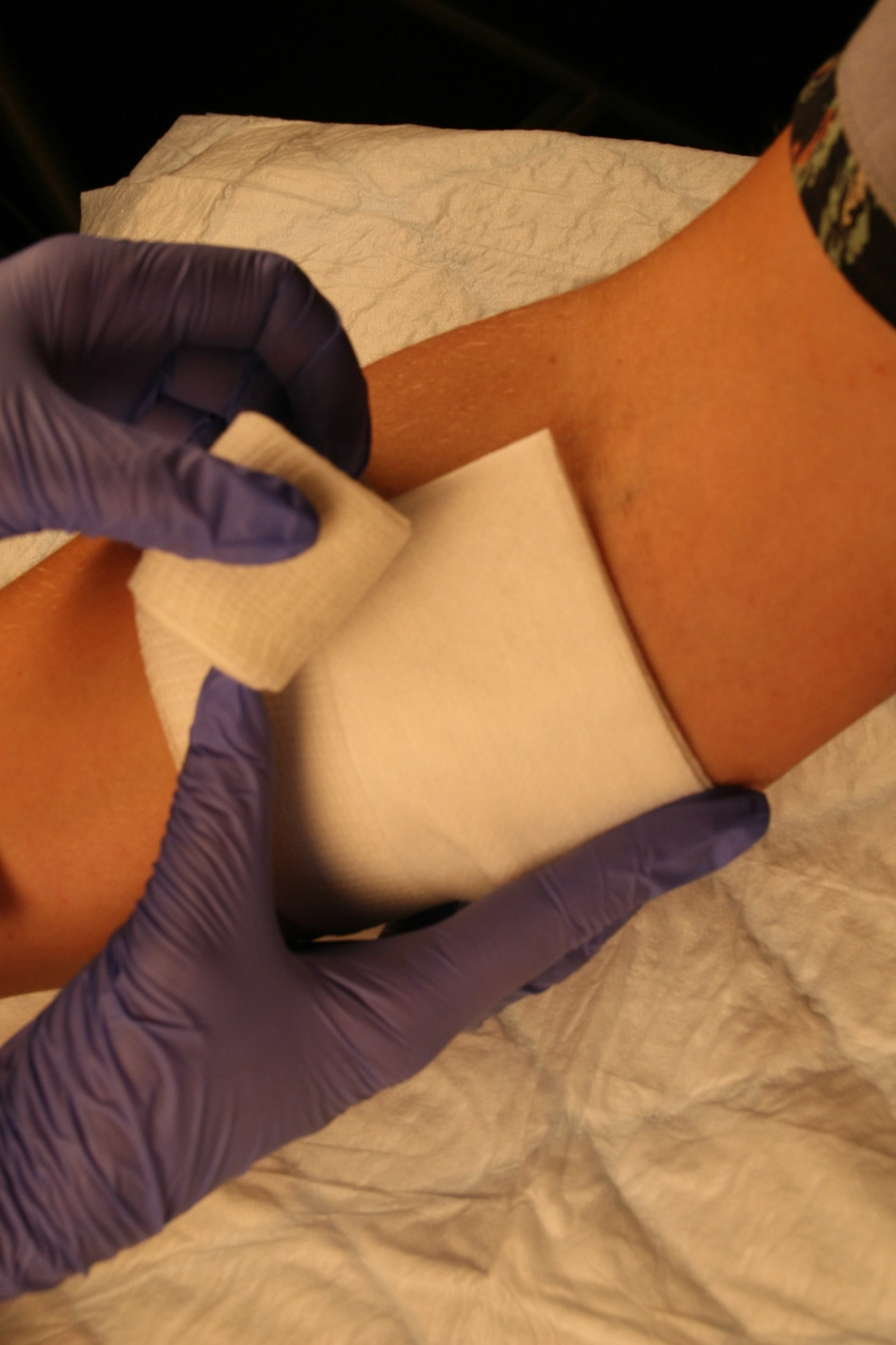 Wundtherapie Eifel - Meike Keul - Verband auf die Wunde anbringen