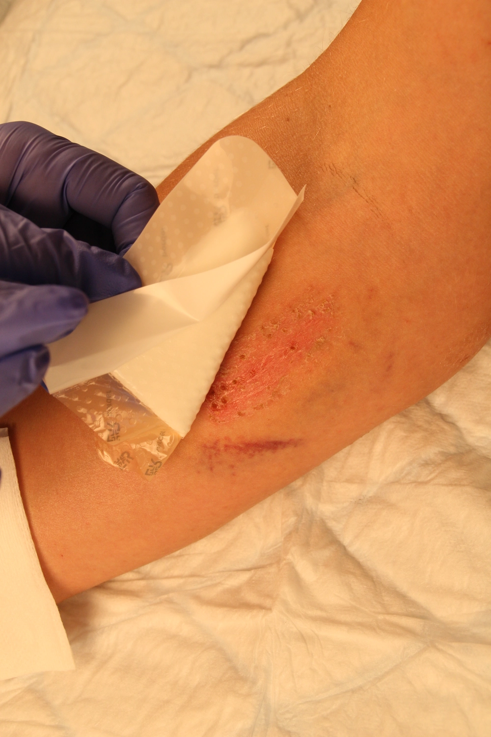 Wundtherapie Eifel - Meike Keul - Verband auf die Wunde anbringen