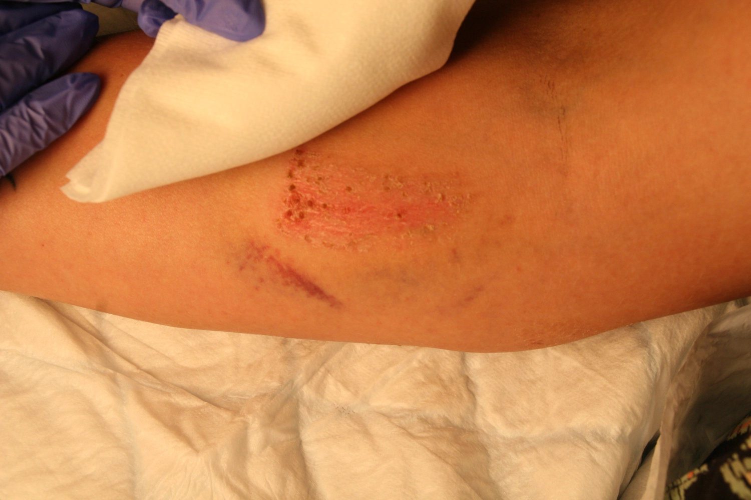 Wundtherapie Eifel - Meike Keul - Wunde