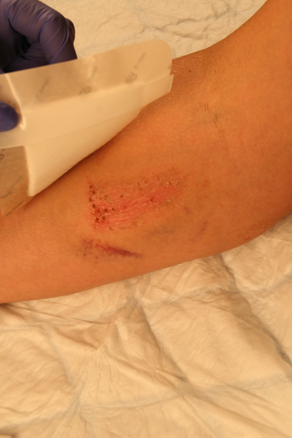 Wundtherapie Eifel - Meike Keul - Wunde